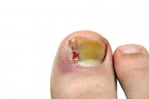 Permenant ingrown toenail removal | Arch City Foot & Ankle