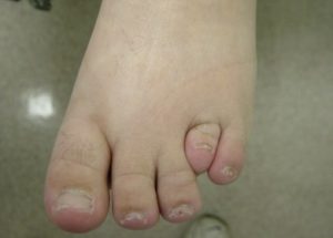 What is Brachymetatarsia?: Podiatry Hotline Foot & Ankle: Foot and